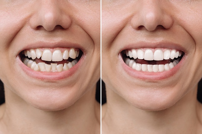 clear aligners before and after